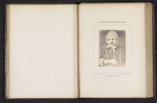 Portrait of an unknown man suffering from pemphigus foliaceus