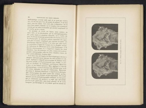 Two macro photographs of tuberculosis in the larynx