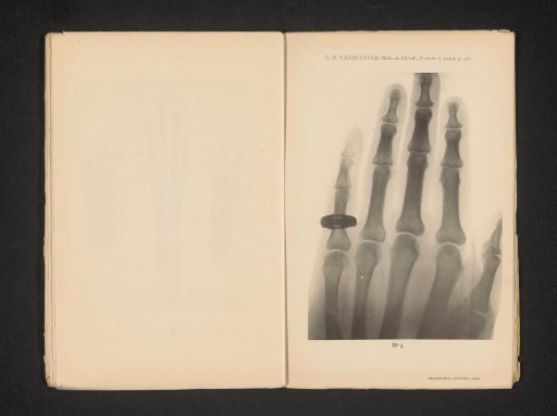 X-ray of a hand