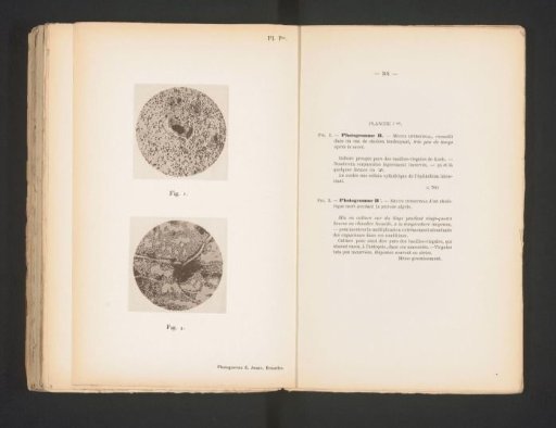 Two microphotographs of the intestinal mucosa of a person who died of cholera