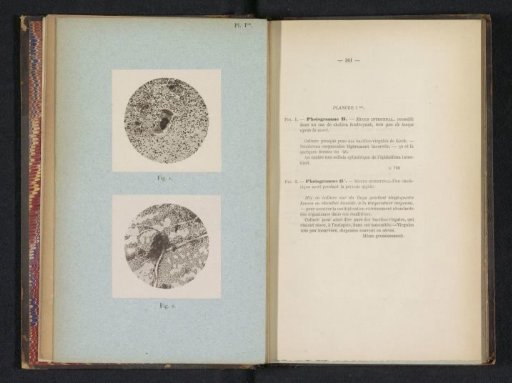 Two microscopic photographs of the intestinal mucosa of a person who died of cholera