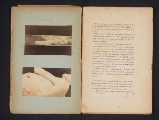 Male body with an incision on the side of the upper body, according to the Estlander method
