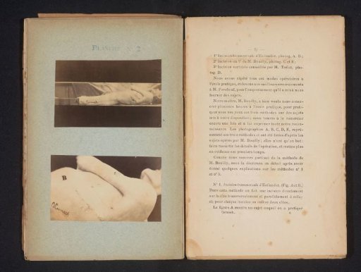 Male body with sutures on the side of the upper body, according to the Estlander method