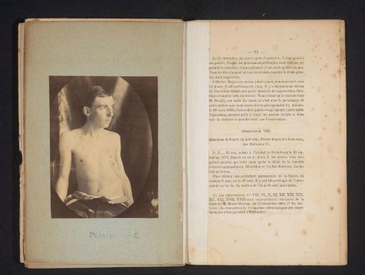 Man with bare upper body, with a scar on the right side of his chest