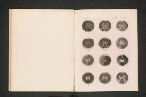 Twelve cross-sections of damaged spines of monkeys
