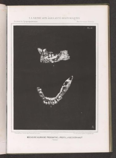Two views of a human jaw, profile and top view