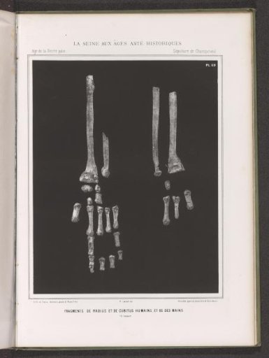 Fragments of the Ulna, Radius, and Bones from the Human Arm and Hand