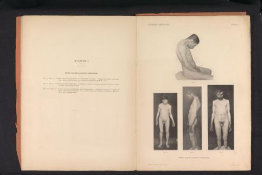 Four views of an unknown man with muscular atrophy