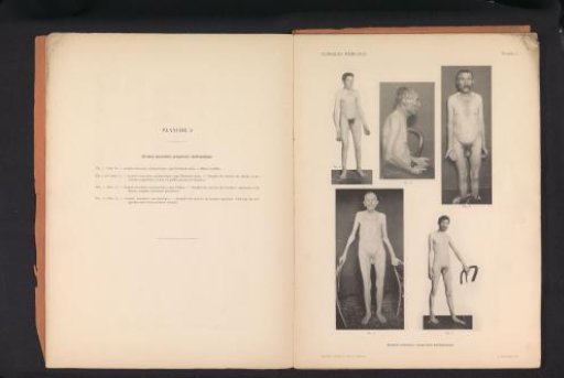 Five views of unknown men with muscular atrophy
