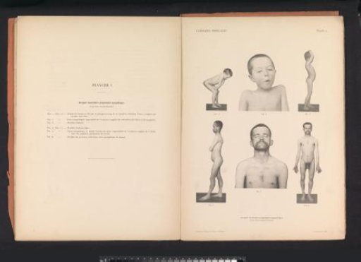 Six views of an unknown boy and man with muscular atrophy