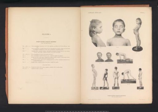 Eleven views of unknown persons with muscular atrophy
