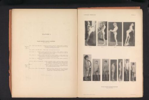 Eleven views of unknown persons with muscular atrophy
