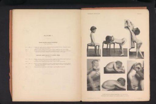 Seven views of children with muscular atrophy