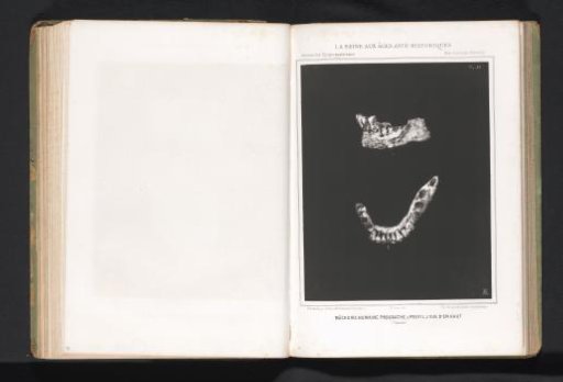 Two views of a human jaw, profile and top view