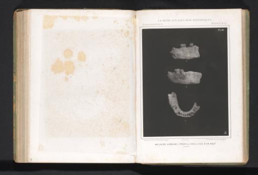 Three views of a human jaw