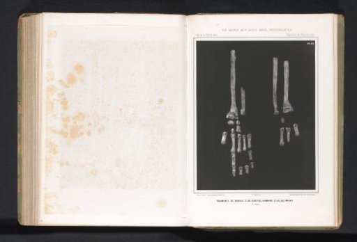 Fragments of the ulna, radius, and bones from the human arm and hand