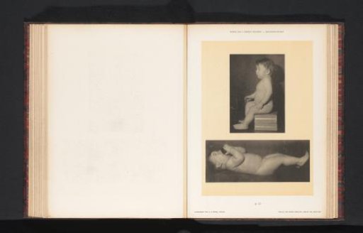 Two images of a nude boy, seated and reclining