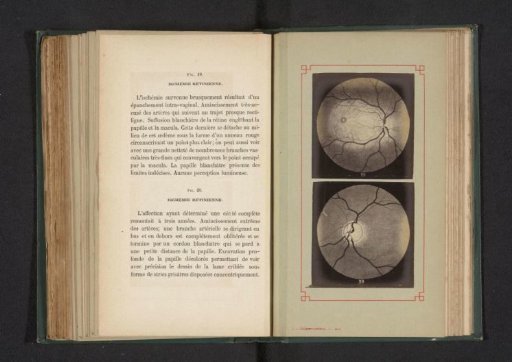 Photoreproduction of two anatomical drawings of insufficient blood circulation in an eye