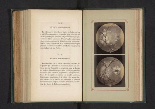 Photoreproduction of two anatomical drawings of an inflammation in the white of the eye