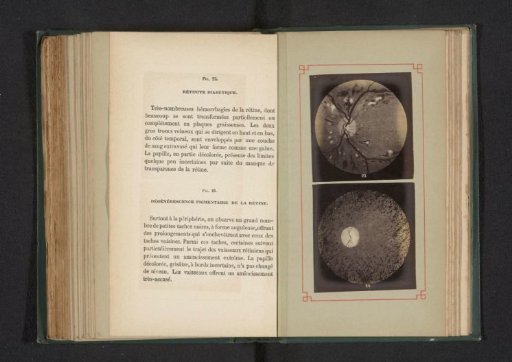 Photoreproduction of two anatomical drawings of an inflammation in the eye and the degeneration of pigment of the retina