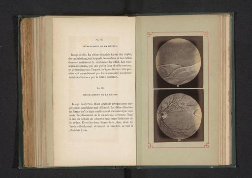 Photoreproduction of two anatomical drawings of the detachment of the retina