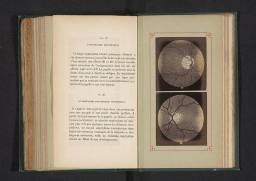 Photographic Reproduction of Two Anatomical Drawings of a Staphyloma of the Eye