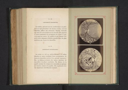 Photographic Reproduction of Two Anatomical Drawings of an Inflammation of the Choroid in the Eye