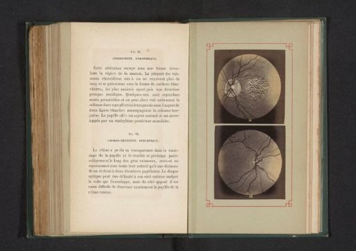 Photographic Reproduction of Two Anatomical Drawings of an Inflammation of the Choroid in the Eye