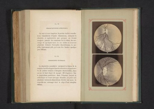 Photographic Reproduction of Two Anatomical Drawings of an Inflammation of the Choroid in the Eye