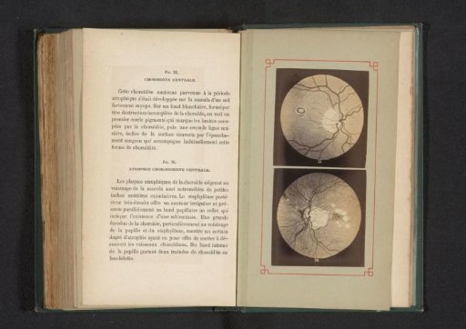 Photographic Reproduction of Two Anatomical Drawings of an Inflammation of the Choroid in the Eye