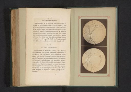 Photographic Reproduction of Two Anatomical Drawings of a Disorder of the Choroid in the Eye