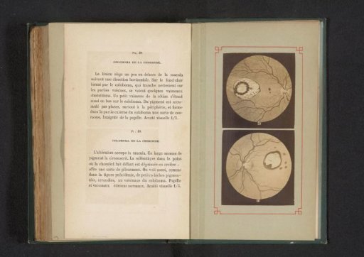 Photographic Reproduction of Two Anatomical Drawings of a Hole in the Choroid in the Eye