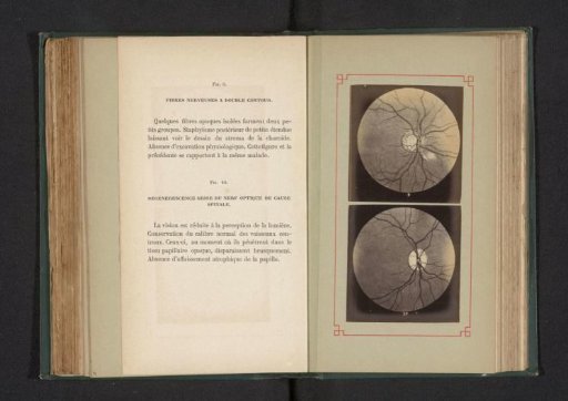 Photoreproduction of two anatomical drawings of the nerves in an eye and the degeneration of an optic nerve