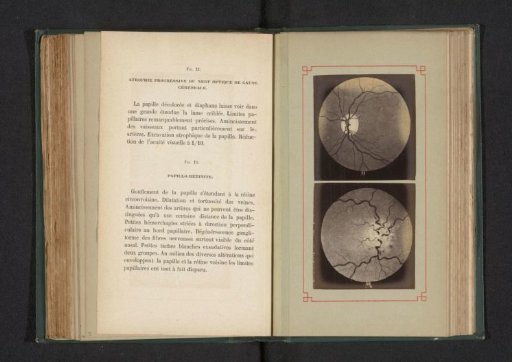 Photoreproduction of two anatomical drawings of progressive atrophy of the optic nerve and inflammation of an optic disc