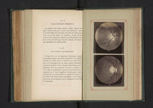 Photoreproduction of two anatomical drawings of a regressive inflammation of an optic disc and deformation of an eye by glaucoma