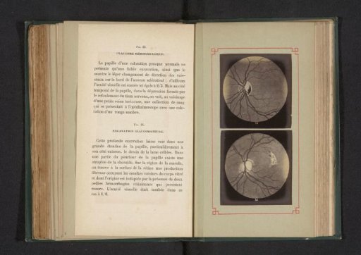 Photoreproduction of two anatomical drawings of a hemorrhage and a deformation of an eye by glaucoma