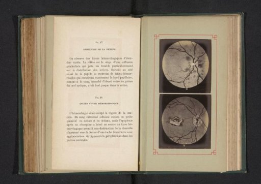 Photoreproduction of two anatomical drawings of a hemorrhage at the retina and a hemorrhage in the eye