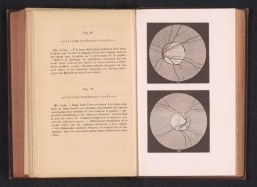 Photographic reproduction of two anatomical drawings of a staphyloma of an eye
