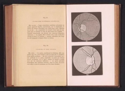 Photographic reproduction of two anatomical drawings of a staphyloma of an eye and a hole in an optic nerve