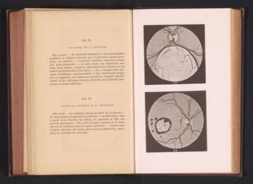 Photographic reproduction of two anatomical drawings of a hole in the choroid of an eye