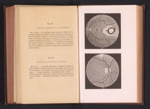 Photographic reproduction of two anatomical drawings of a hole in the choroid of an eye and atrophy of an optic nerve