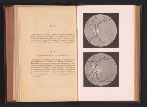 Photographic reproduction of two anatomical drawings of atrophy and neuritis of an eye