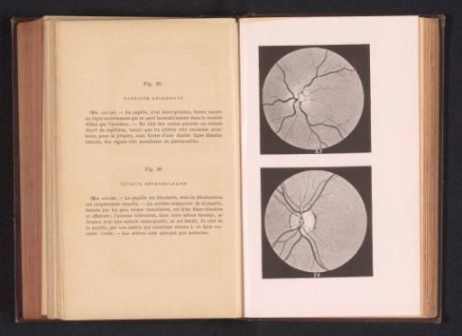 Photographic reproduction of two anatomical drawings of nerve disorders of an eye