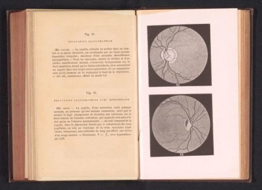 Photographic reproduction of two anatomical drawings of a deformation of an eye due to glaucoma