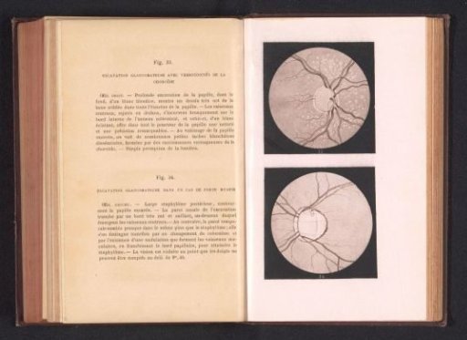Photographic reproduction of two anatomical drawings of an affection of an eye by glaucoma