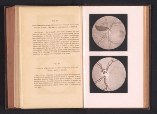Photographic reproduction of two anatomical drawings of hemorrhages in an eye