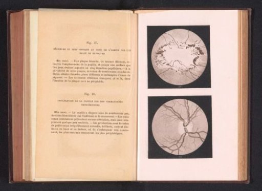 Photographic reproduction of two anatomical drawings of a rupture of an optic nerve and an eye disorder of a pupil