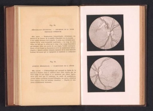 Photographic reproduction of two anatomical drawings of hemorrhages in an eye