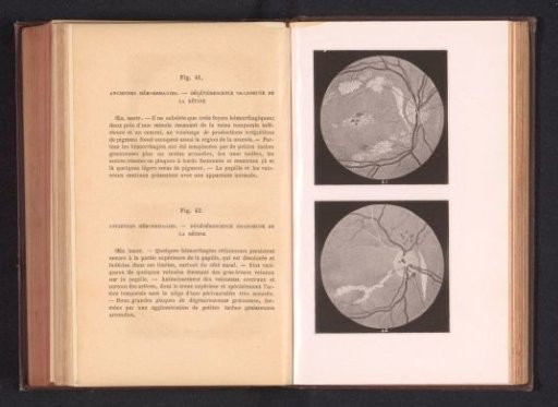Photographic reproduction of two anatomical drawings of hemorrhages in an eye