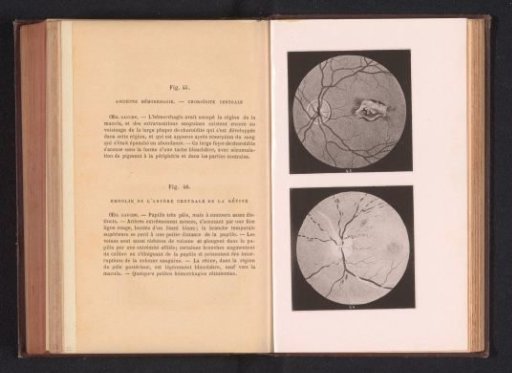 Photographic reproduction of two anatomical drawings of a hemorrhage and embolism in an eye